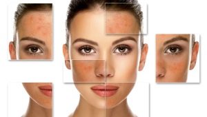 Salicylic peeling: features and rules of application
