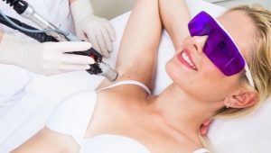 Epilation with alexandrite laser