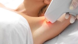 How many laser hair removal procedures do you need to completely remove hair?