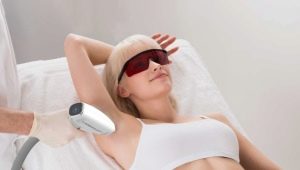 What is photoepilation and how is it done?