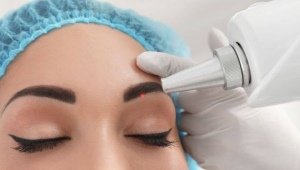 Laser tattoo removal