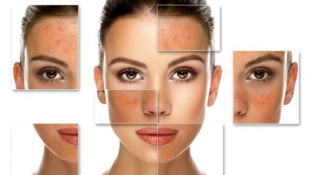 Salicylic peeling: features and rules of application