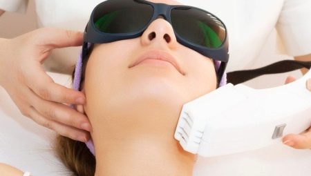 Laser peeling: description of the procedure, benefits and harms from it