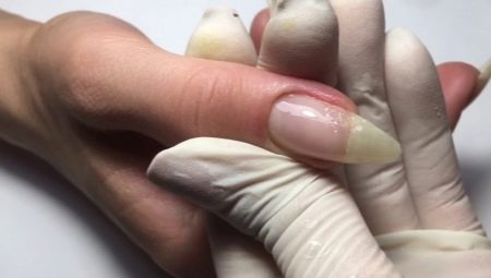 Features of the extension of a broken nail