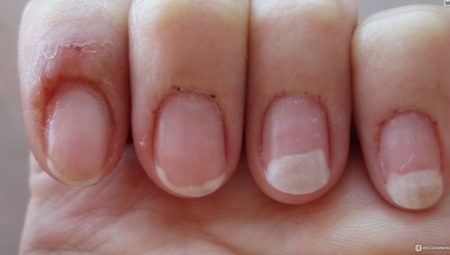 Allergy to gel polish: causes, symptoms and treatment methods
