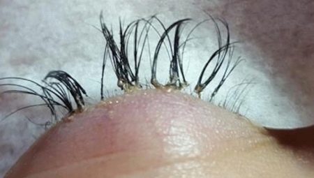 Unsuccessful eyelash extension: causes and consequences