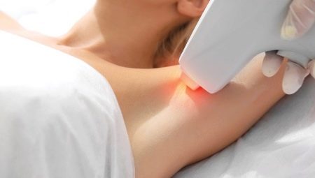How many laser hair removal procedures do you need to completely remove hair?