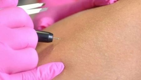 Electrolysis deep bikini