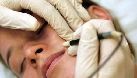 All about facial electrolysis