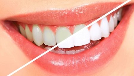 How to whiten teeth at home?