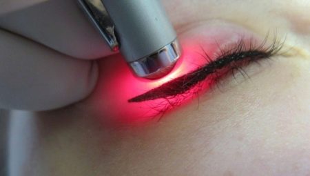 Eyelid tattoo removal