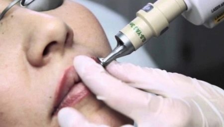All about lip tattoo removal