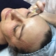Papules after biorevitalization: why do they appear and when do they disappear?