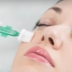 Chemical peeling: when and how can it be done?