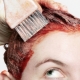 Hair dye allergy