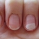 Allergy to gel polish: causes, symptoms and treatment methods