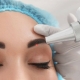 Laser tattoo removal