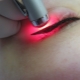 Eyelid tattoo removal